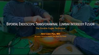 Paos Biportal Endoscopic Transforaminal Lumbar Interbody Fusion BETLIF using Double Cages [upl. by Cherian]