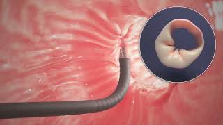 Endoscopic Sleeve Gastroplasty ESG Procedure Animation [upl. by Fendig]