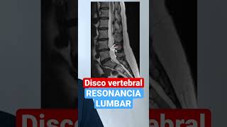 Resonancia Magnética 🧲 Lumbar 11 dolordeespalda radiologia herniadedisco 👇 [upl. by Violetta]