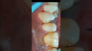 Scaling and Air Polishing using Prophymate teeth teethcleaning teethwhitening [upl. by Yecak378]