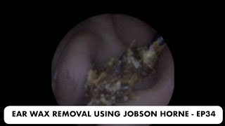 EAR WAX REMOVAL USING JOBSON HORNE  EP34 [upl. by Aia]