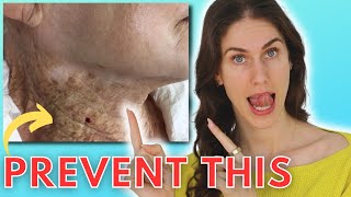 ☀️ 9 SHOCKING Things Sun Does To Your Skin Actinic Keratosis Rhinophyma ￼Solar Elastosis amp More [upl. by Tod]