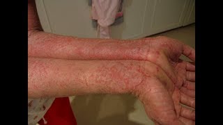 Treatment of eczema and other skin diseases [upl. by Carey720]