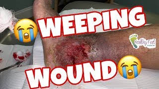 Weeping Wound [upl. by Eibloc]