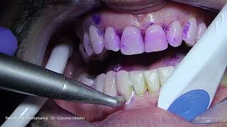 PROPHYLAXIS  Dr Giacomo Oldoini  Periodontal Mantainance [upl. by Hymen]