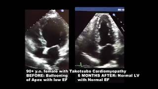 2d Echocardiogram takotsubo Cardiomyopathy [upl. by Kcirdahc892]