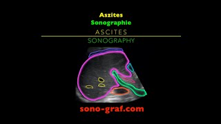 Sonographie  As­zi­tes [upl. by Sadye]