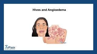 Hives and Angioedema [upl. by Sokem632]