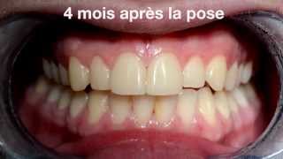 Facettes dentaires Cerec  veneers by PAG vs Ceramic crown [upl. by Nosduh]