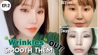 SUB Mongolian youtuber Grace Choi gets her eyelids smoothened 3 months postop [upl. by Anilorak572]