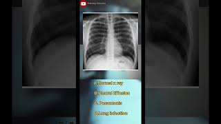 🤔Chest xrayCXRchestxrachestxraynormalpleuraleffusionpneumonialungsviralradiologyshorts [upl. by Thury]