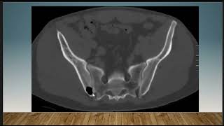 Short Case Discussion  Intraosseous pneumatocyst [upl. by Kirima]