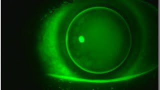 Multifocal GP Contact Lenses Video 3 [upl. by Llehcal]