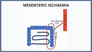 Mesenteric Ischaemia Explained [upl. by Amelus]