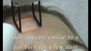 Fractional CO2 laser treatment Norwich Norfolk UK [upl. by Anirrok]