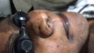 Carbon LASER Skin Toning and Peeling Visakhapatnam [upl. by Mackie]