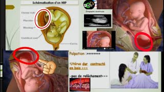 Cours En Ligne  HRP  Hématome Retroplacentaire Tableau Médical [upl. by Cart]