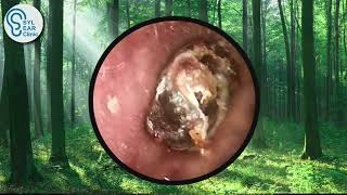 7 YEARS Untreated Impacted Ear Wax  SYL CLINIC [upl. by Thaine]