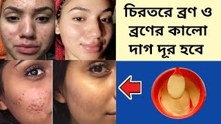 চিরতরে ব্রণ ও ব্রণের কালো দাগ দূর করার উপায়ফর্সা হওয়ার সহজ উপায়pimple dur korar upaypigmentation [upl. by Abisia]