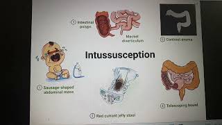 Intussusception part 1 [upl. by Oznecniv740]