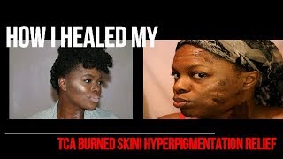 How to fix TCA burned skin Clearing Hyperpigmentation How to get Flawless Skin [upl. by Aleen]