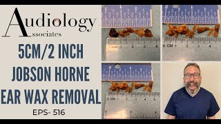 5CM2INCH JOBSON HORNE EAR WAX REMOVAL  EP516 [upl. by Martino327]