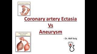 Coronary Ectasia Vs Aneurysm Dr Akif Baig [upl. by Eninnaj]