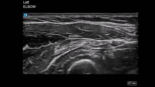 Elbow Ultrasound Radial Nerve Hydrodissection [upl. by Kingsley559]