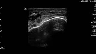 Knee Ultrasound Prepatellar Bursa Injection Part 1 [upl. by Ysdnil604]