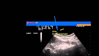 Ultrasound guided S1 transforaminal blockcurve probe [upl. by Asenev]