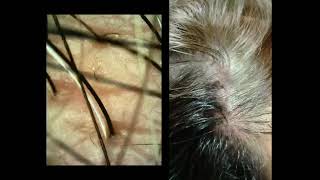 SKIN TALKSCALP GETTING FUNGAL INFECTion TINEA CAPITISRINGWORM OF THE SCALP [upl. by Anaihs155]