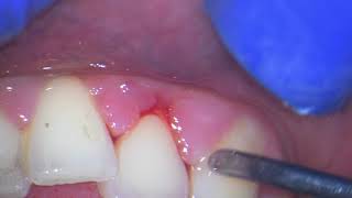 Ultrasonic teeth cleaning watch why your gums bleed [upl. by Hermann]