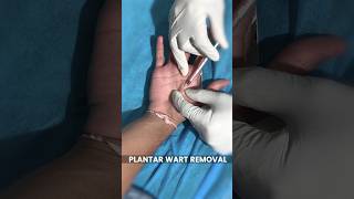 Plantar Warts Removal Treatment at Skinaa Clinic viral shorts [upl. by Thaddaus]