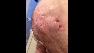 Hidradenitis one of the top ten painful diseases I am doing this with no pain meds [upl. by Naujak]