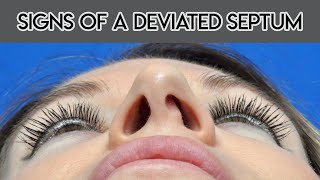 Signs of a Deviated Septum [upl. by Ettenawtna]