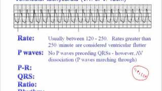 ECG Ventricular Tachycardia VT [upl. by Krystal]