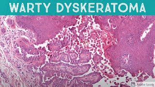 Warty Dyskeratoma acantholytic dyskeratosis patterndermatology pathology dermatopathology [upl. by Leorsiy910]