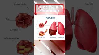 Lung sound in Pneumonia [upl. by Barbara]