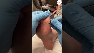 Big Toe Callus Removal by Podiatrist undefined [upl. by Huberty]