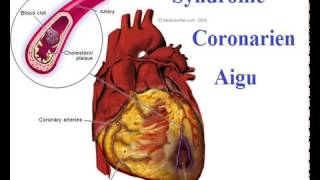 Syndrome coronarien Conduite à Tenir devant une crise cardiaque [upl. by March]