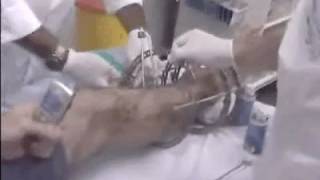 Part 2 External Fixation Removal  Ilizarov to full leg cast [upl. by Amehsyt]