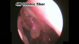 Nasal Polyps Laser Surgery [upl. by Novel963]