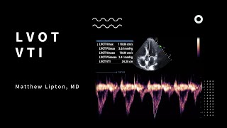 How to use the LVOT VTI to determine fluid responsiveness for the critically ill patient [upl. by Atinniuq909]