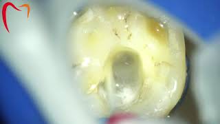 A simple technique to activate Root Canal Irrigants amp Microsuction [upl. by Annorah]