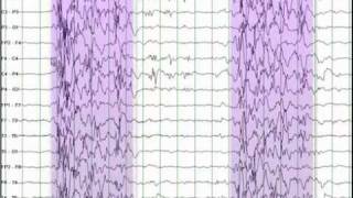 EEG Reading Rounds Burst Suppression [upl. by Otti471]