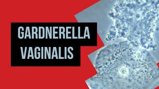 Gardnerella VaginalisBacterial Vaginosis Amsel Criteria  Nugent Score Microbiology [upl. by Ardnosac164]