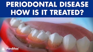 Periodontitis and its influence on health  How is periodontal disease treated © [upl. by Greenland]