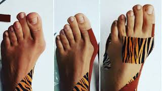 Fysio Physics 4xT Methode® 4MTOR® Hallux Valgus [upl. by Liliane752]