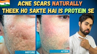 Remove Acne Scars Naturally  3 Remedies 100 Works With Results [upl. by Nodnol]