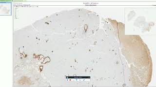 Cerebral Amyloid Angiopathy  Adventures in Neuropathology [upl. by Lettie]